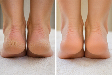 Без пемзы, терок и боли - и пятки "как наждачка" исчезли за 1 раз: просто мажу кожу пастой